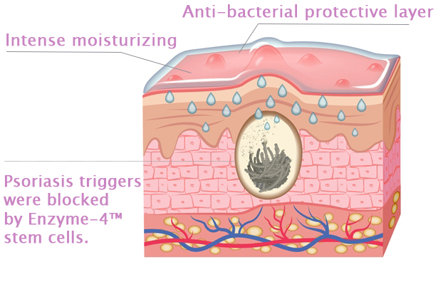 Psoriasis triggers were blocked by stem cells.